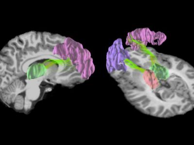 Playing high school football changes the teenage brain